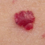 hemangioma
