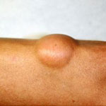 lipoma