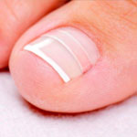uñas_encarnadas
